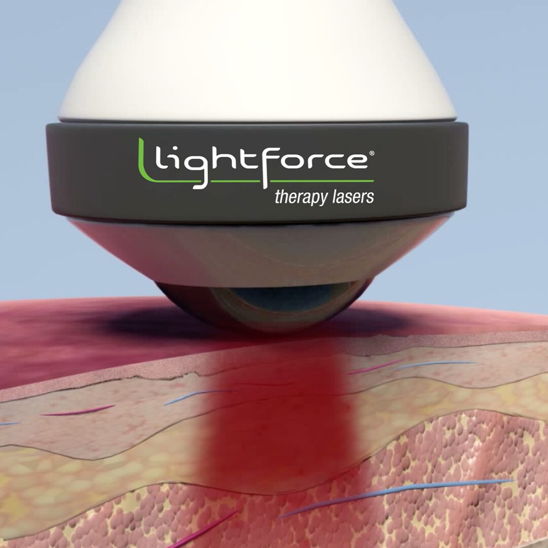 Lightforce class iv laser therapy